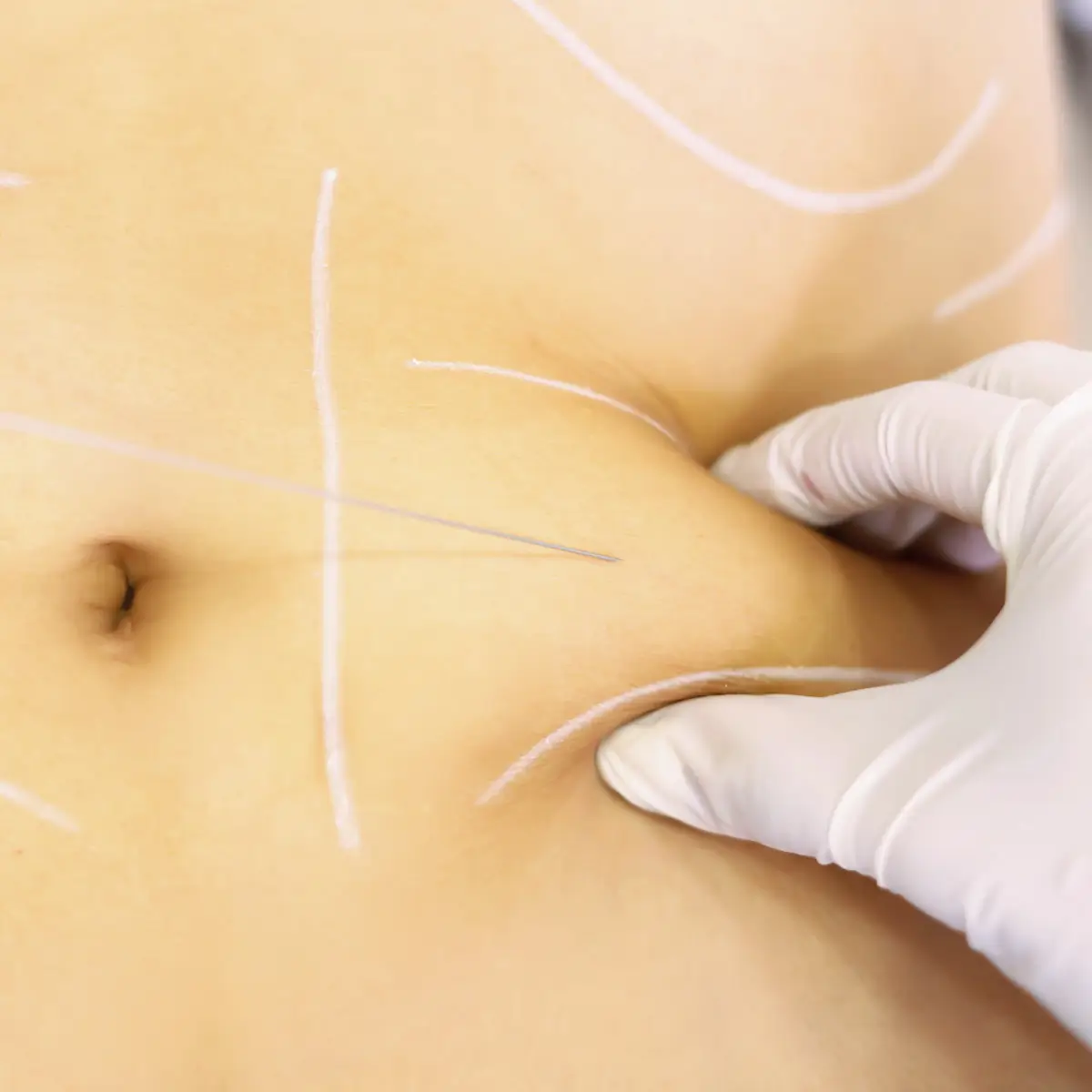 canvasskin servicios estetica facial y corporal reduccion de grasa localizada